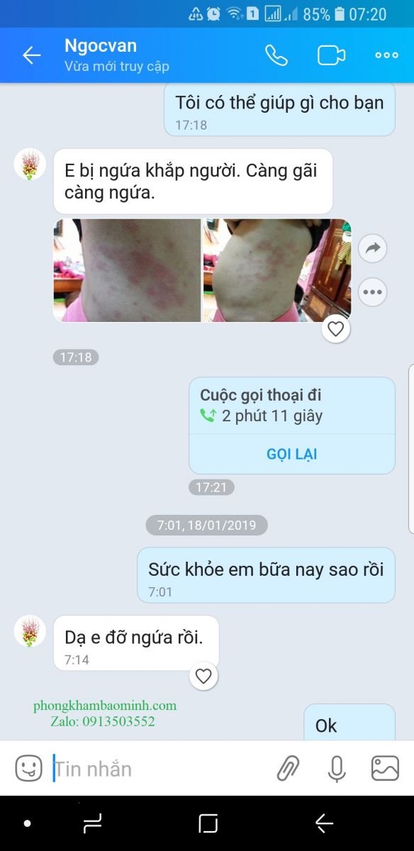 Dị ứng nổi mề đay